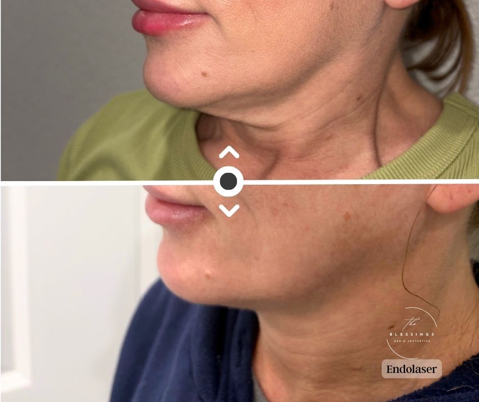 Endolaser Before & After