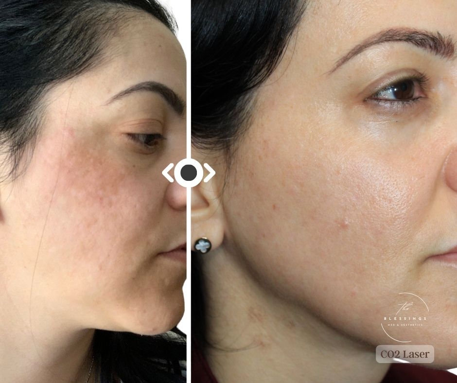 CO2 Laser Before & After