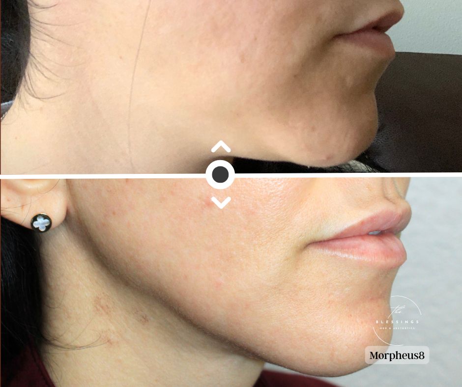 Morphues8 Before and After
