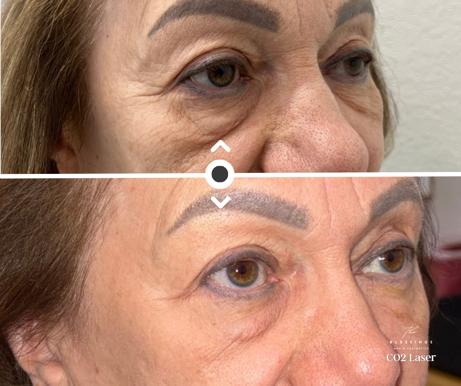CO2 laser Before and After
